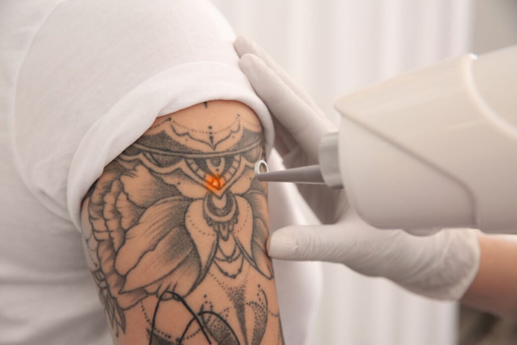 Laser tattoo removal on a man