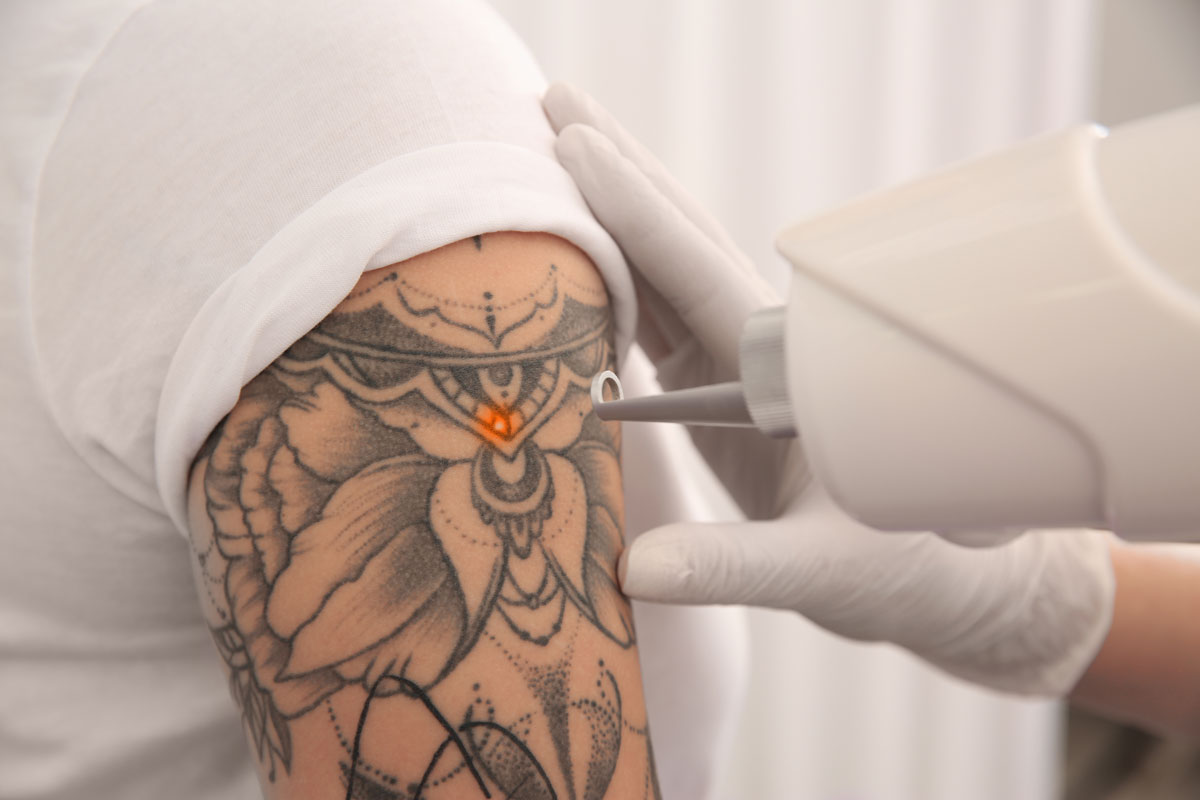 Tattoo Removal Lasers Outshine Other Methods